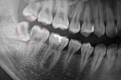 正常な歯が歯周病になってしまう