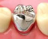 小臼歯歯根が1本で被せ物が金属